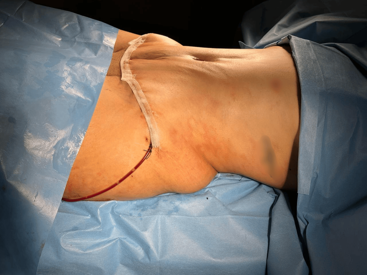 Abdominoplastie + Lipo 360 - Après 1