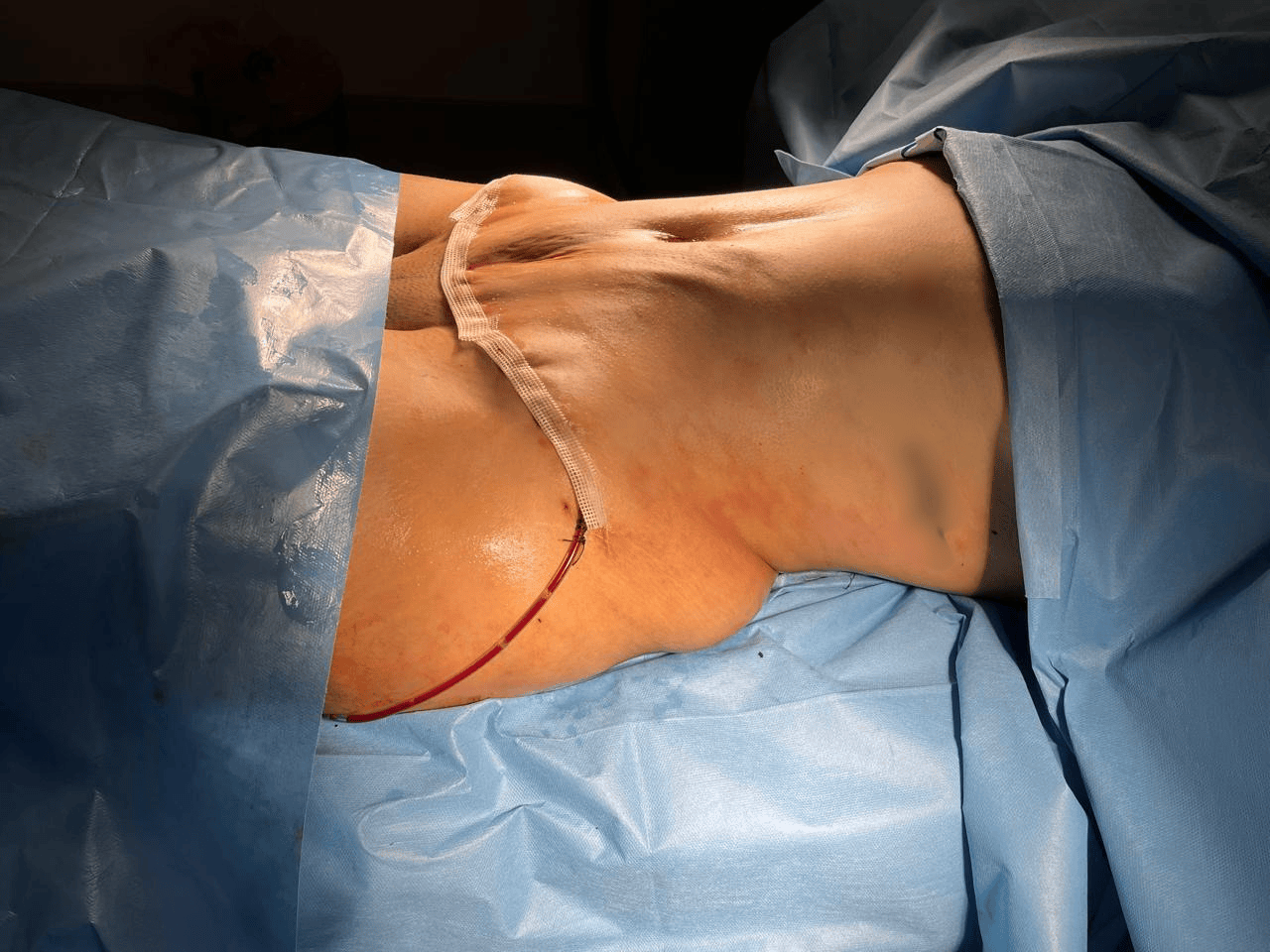 Abdominoplastie + Lipo 360 - Après 2
