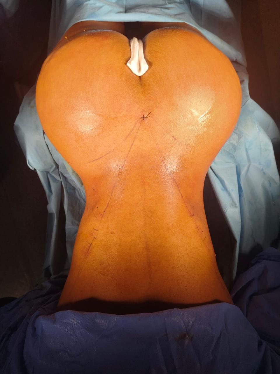 Liposculpture + RibXcar (remodelage costal) + Skinny BBL - Après 4